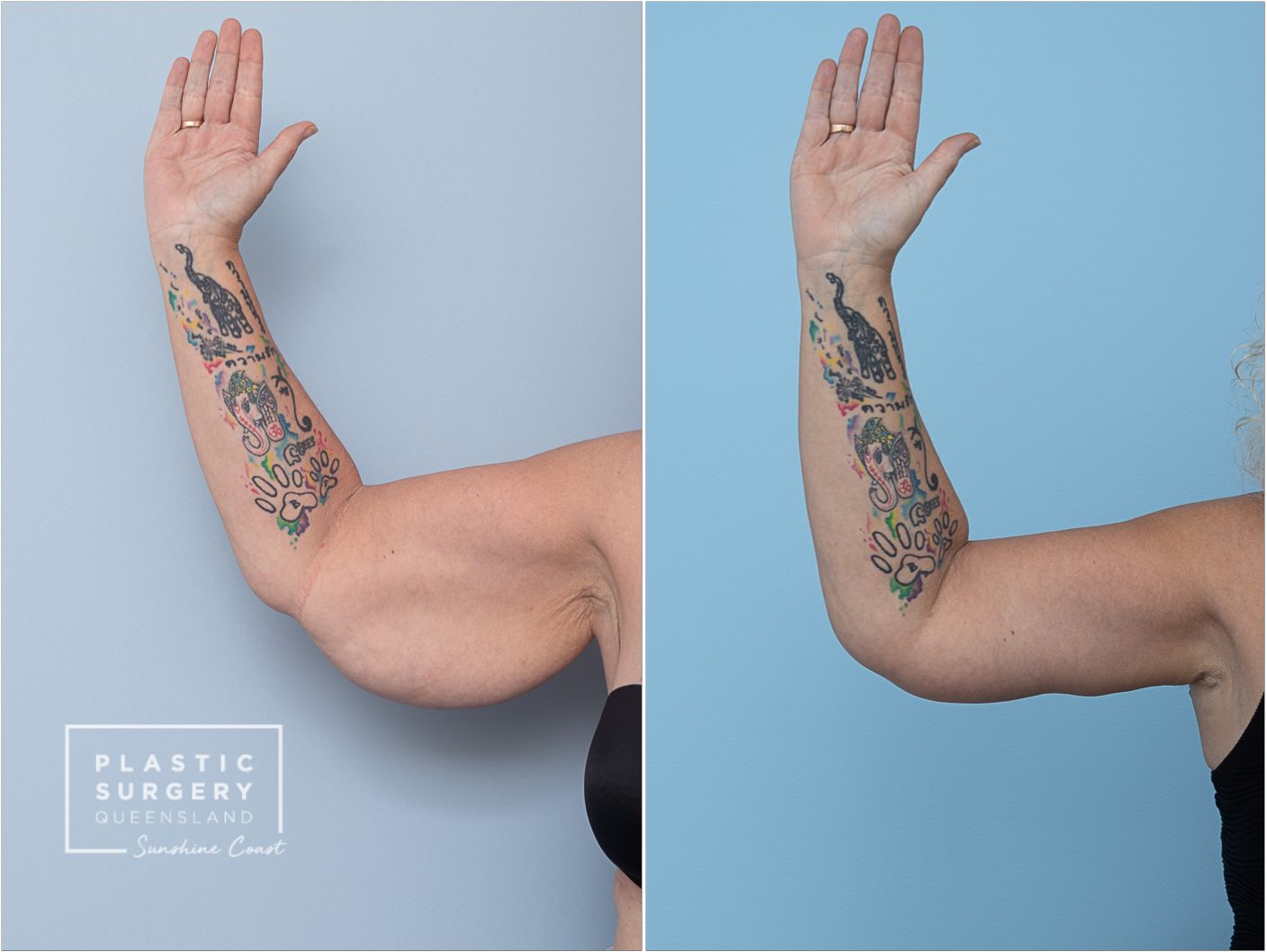 Arm Lift (Brachioplasty) — clinical photograph (non-identifying)