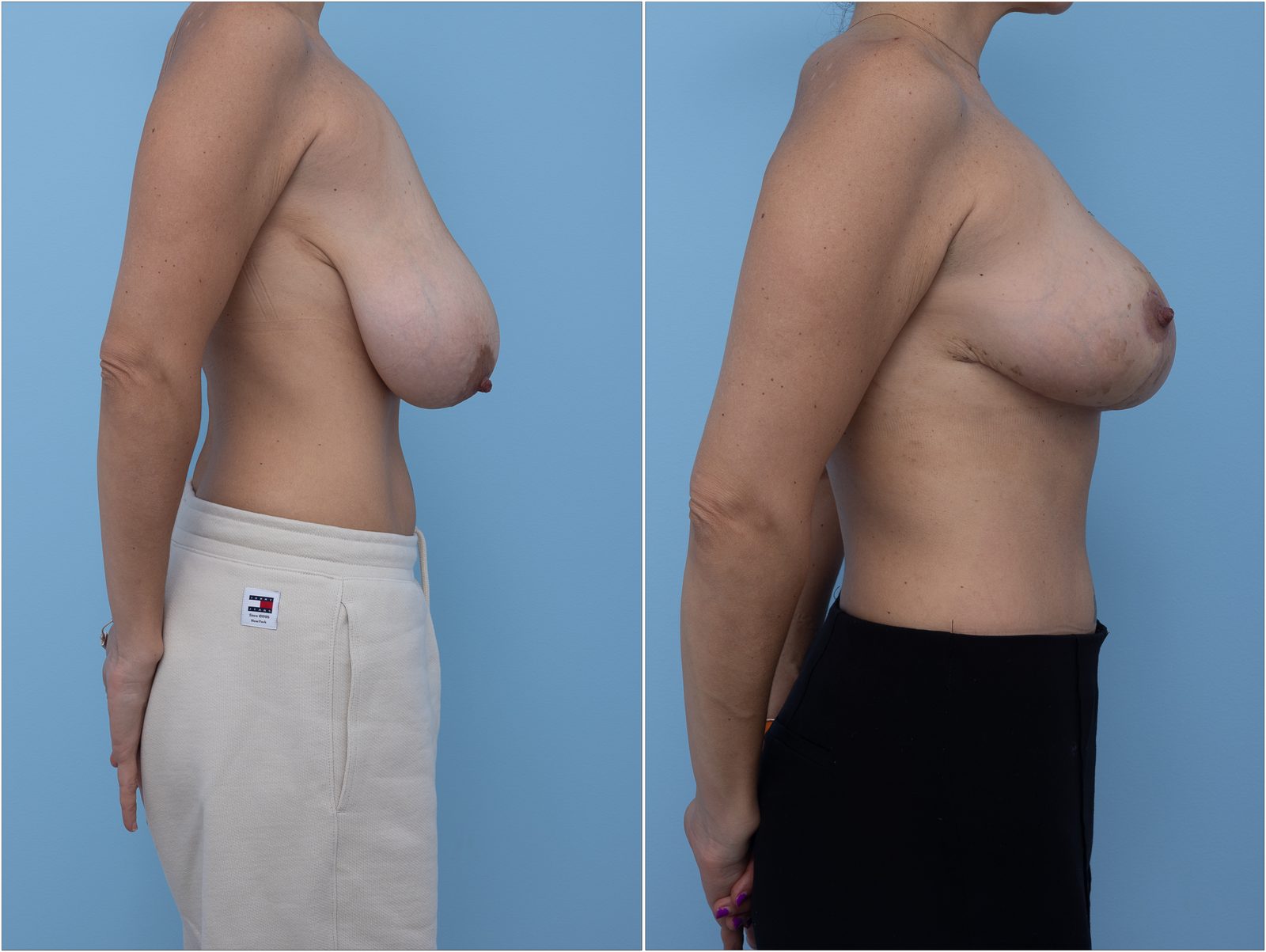 Breast Lift (Mastopexy) — clinical photograph (non-identifying)