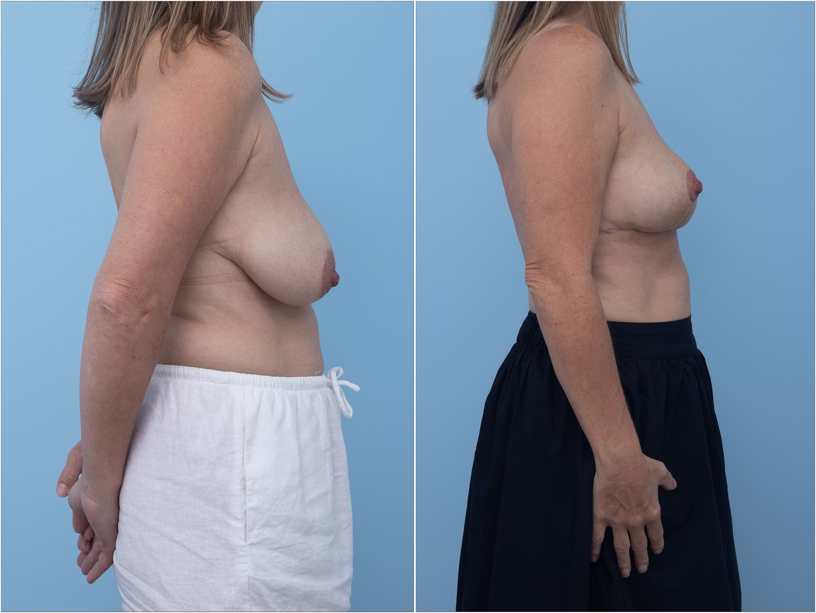 Breast reduction result, side view — non-identifying