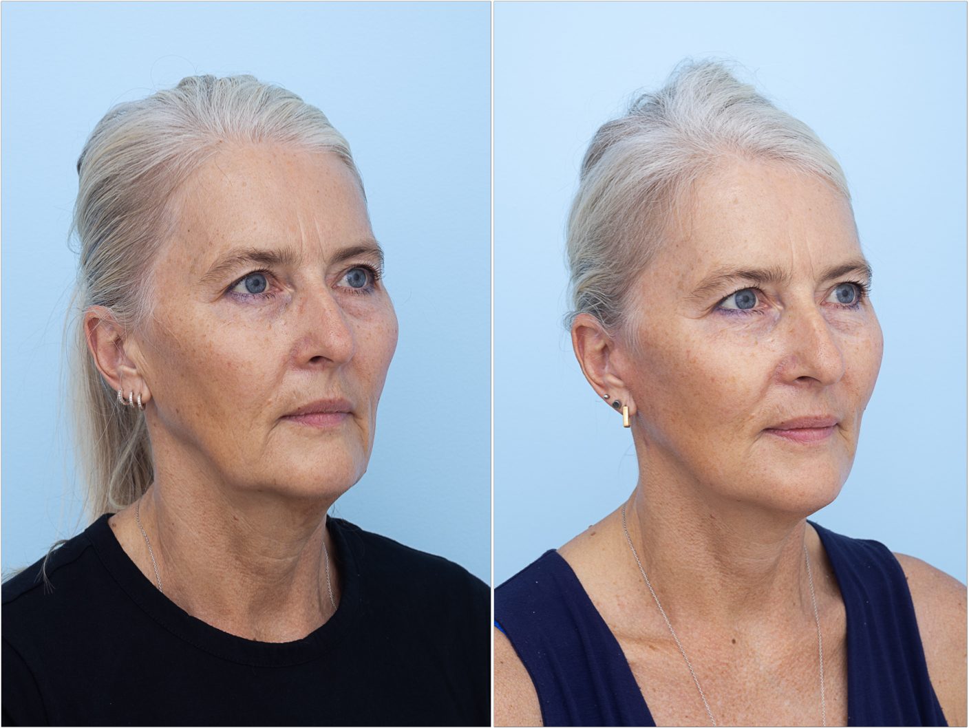 Mini Facelift — clinical photograph (non-identifying)